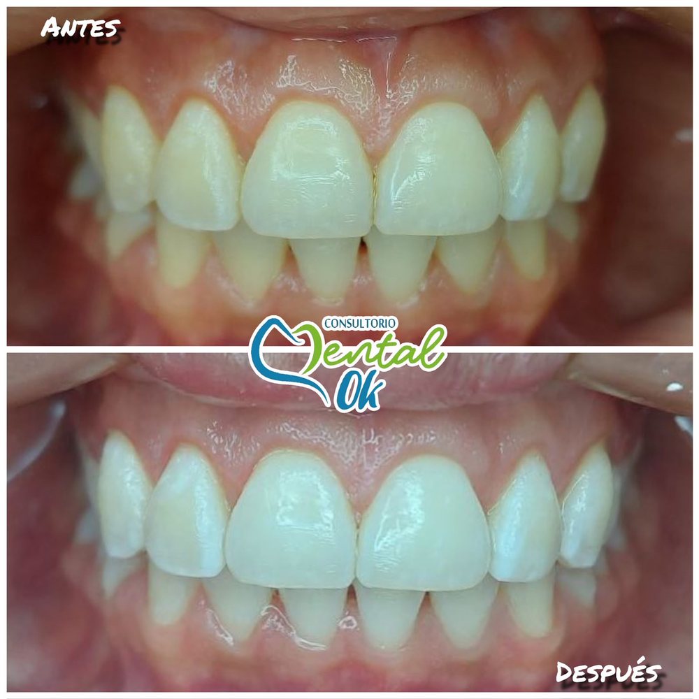 Antes y después de un blanqueamiento dental, dientes superiores e inferiores de frente