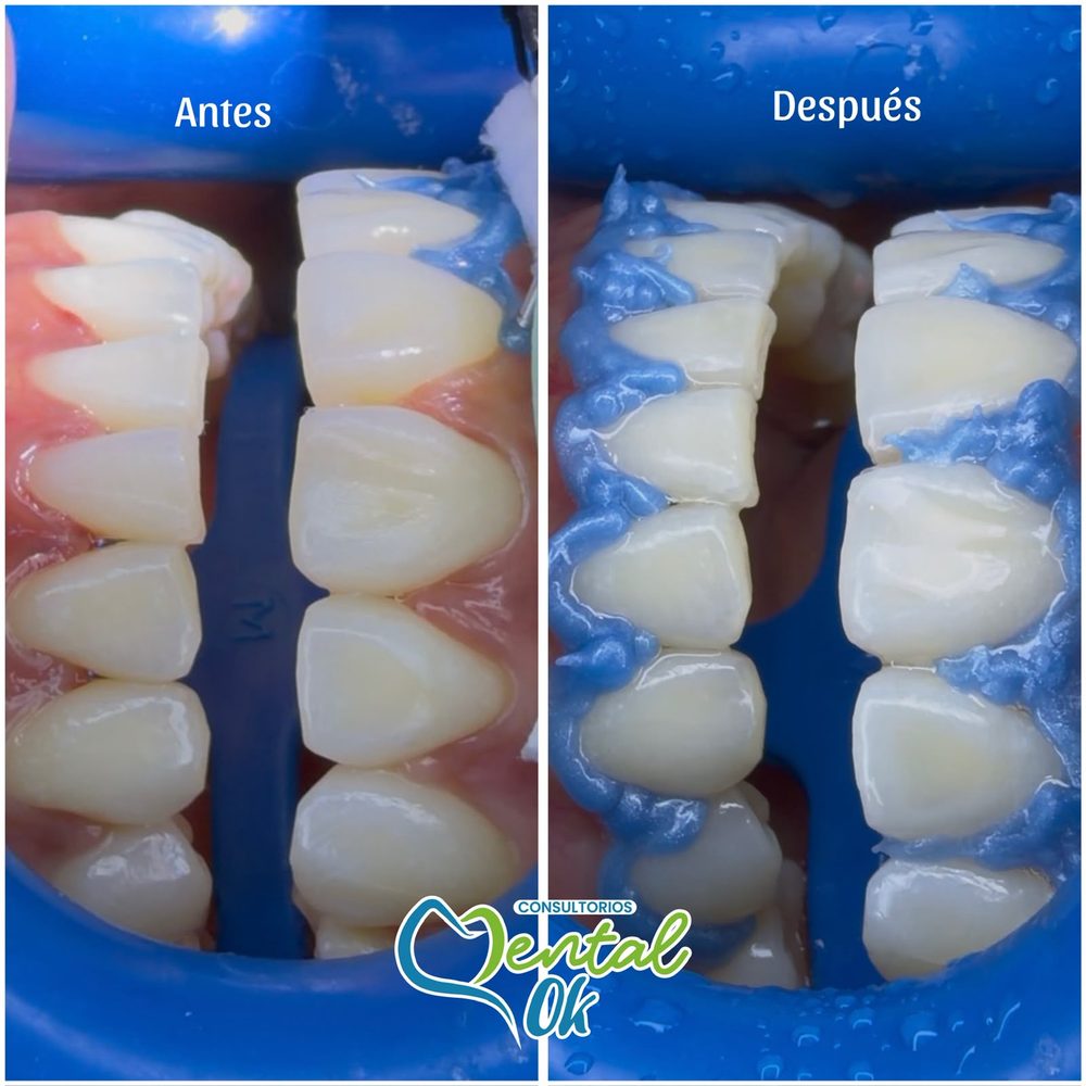 Antes y después de un blanqueamiento dental, con protección de encías en color azul