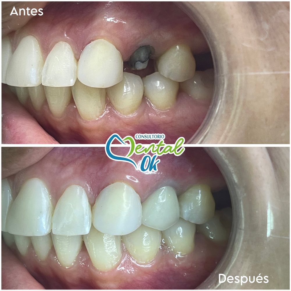 Antes y después de una corona sobre un diente muy dañado en la zona lateral superior