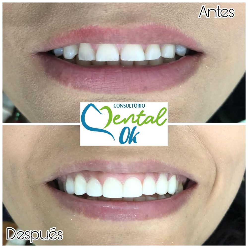 Antes y después de un diseño de sonrisa en los dientes superiores