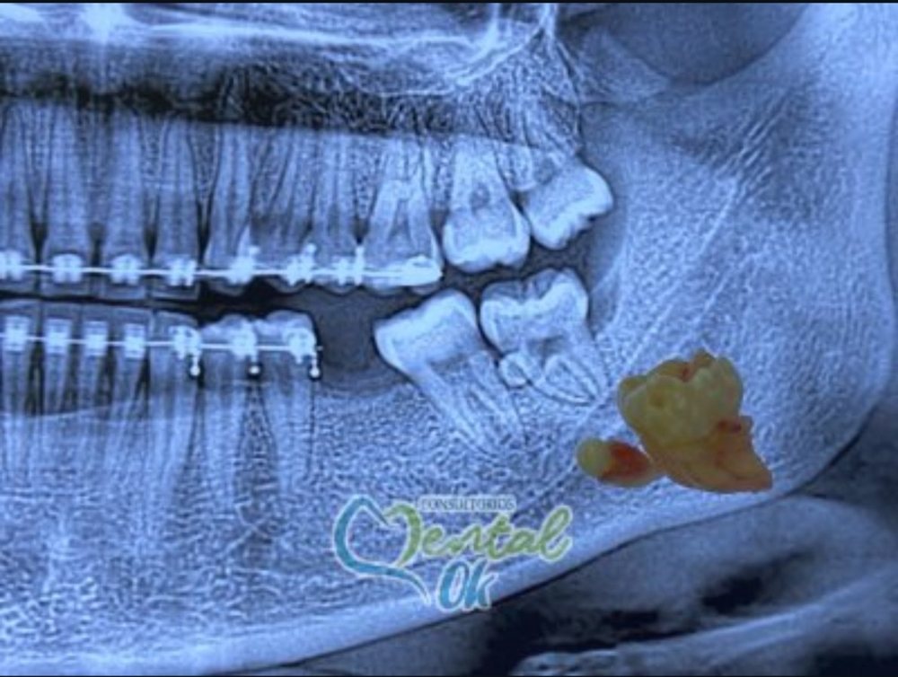 Radiografía panorámica de un paciente con brackets junto a la muela del juicio que se le extrajo