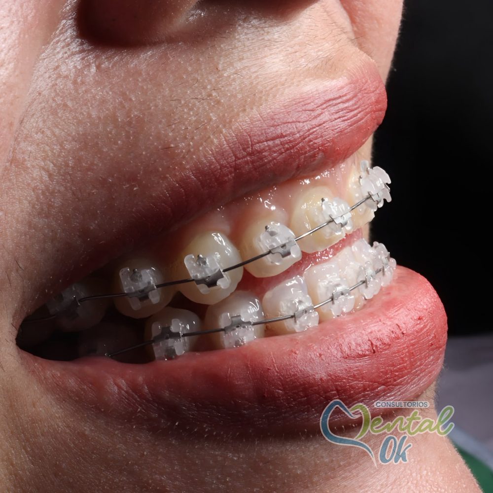 Paciente con brackets estéticos transparentes, vista de perfil