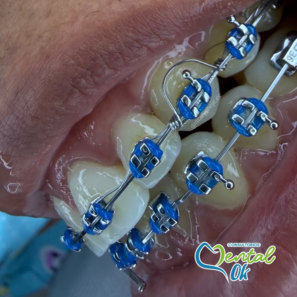 Brackets metálicos con ligas azules durante el tratamiento de ortodoncia, vista de cerca