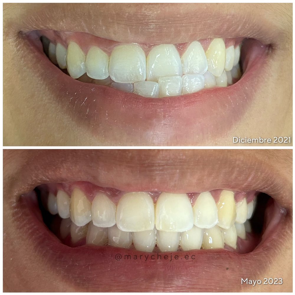 Sonrisa antes y después de la ortodoncia, de diciembre de 2021 a mayo de 2023