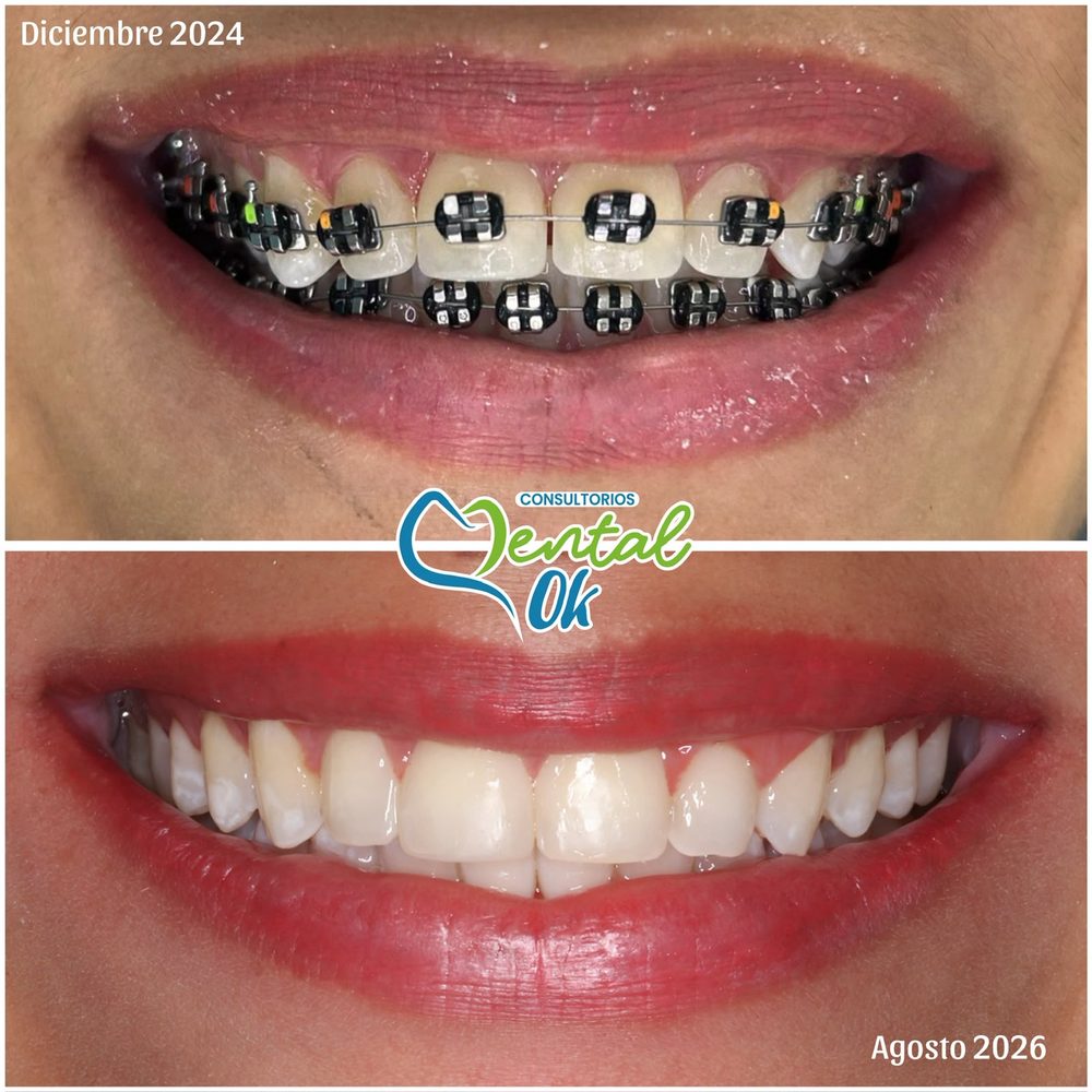 Sonrisa con brackets en diciembre de 2024 y sin brackets en agosto de 2026, caso de ortodoncia en Dental OK