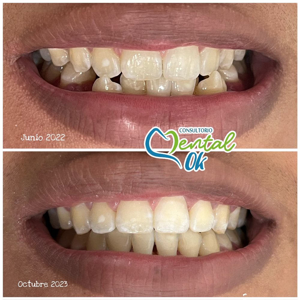 Sonrisa antes y después de la ortodoncia, de junio de 2022 a octubre de 2023