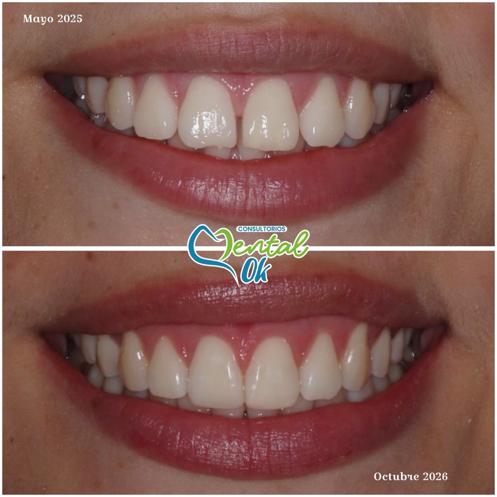 Sonrisa antes y después de la ortodoncia, de mayo de 2025 a octubre de 2026, con cierre del espacio entre los dientes delanteros