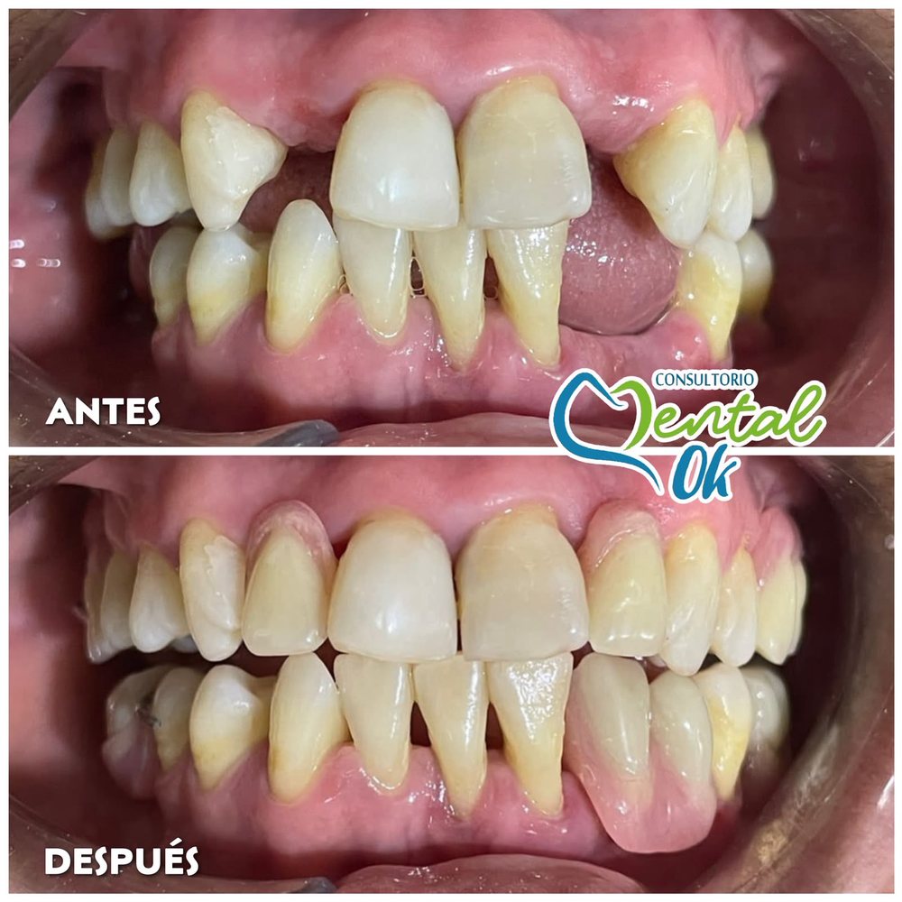 Antes y después de una prótesis que reemplaza dientes faltantes a los lados de los dientes delanteros