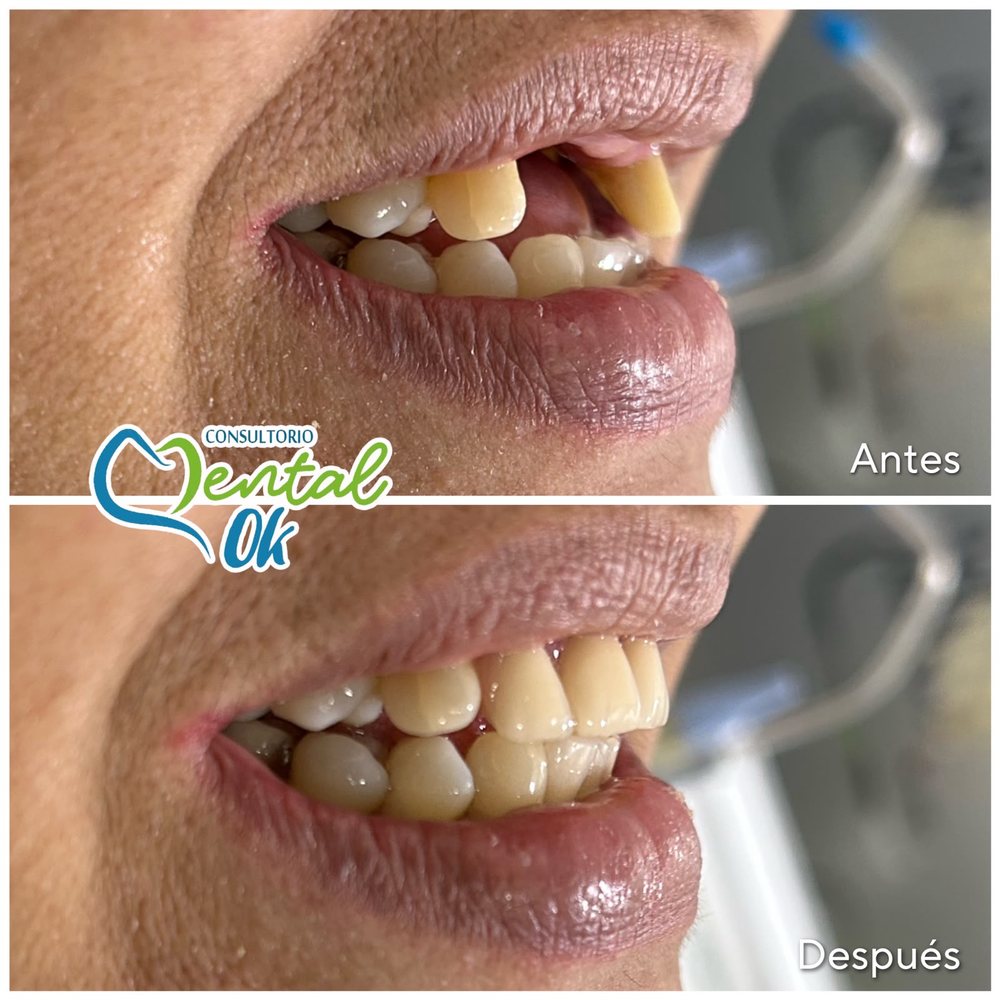 Antes y después de una prótesis dental que reemplaza los dientes delanteros superiores, vista de perfil
