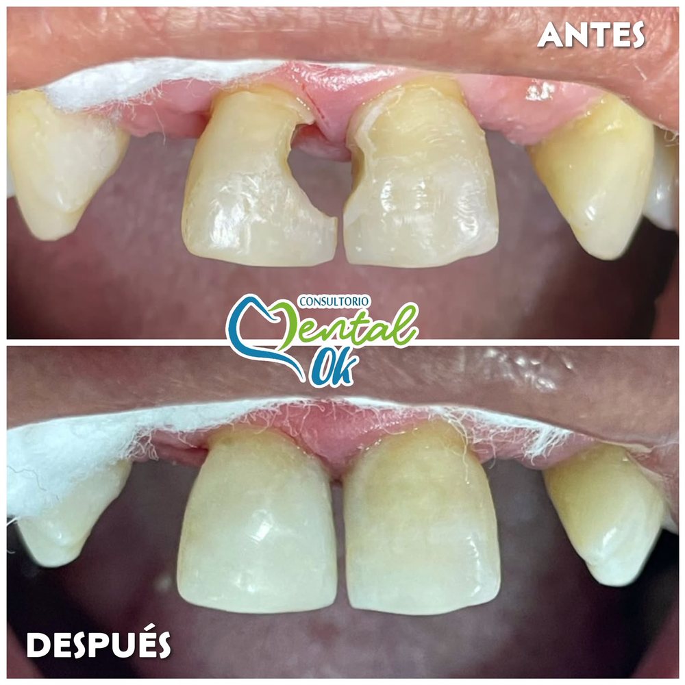 Antes y después de la restauración estética con resina de los dos dientes delanteros fracturados
