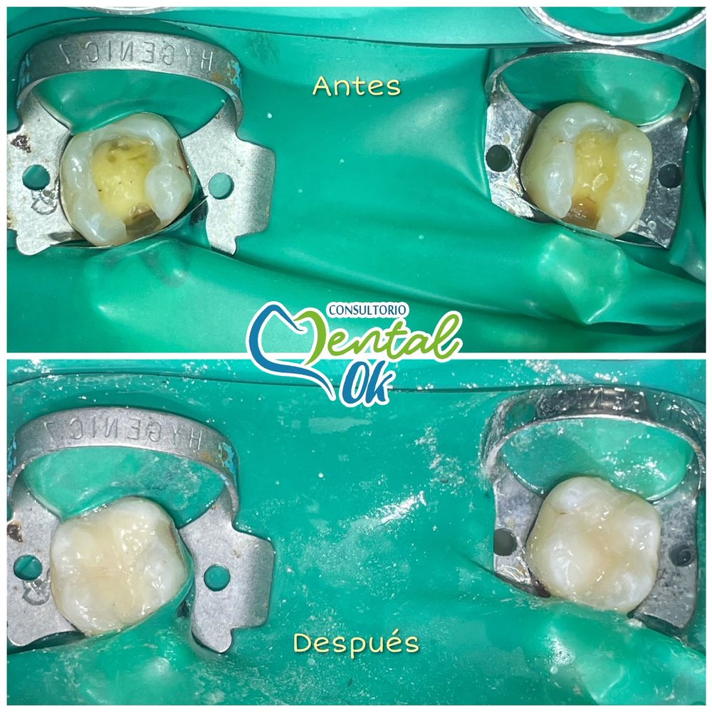 Antes y después de la restauración con resina de dos muelas con caries, con aislamiento para trabajar en seco