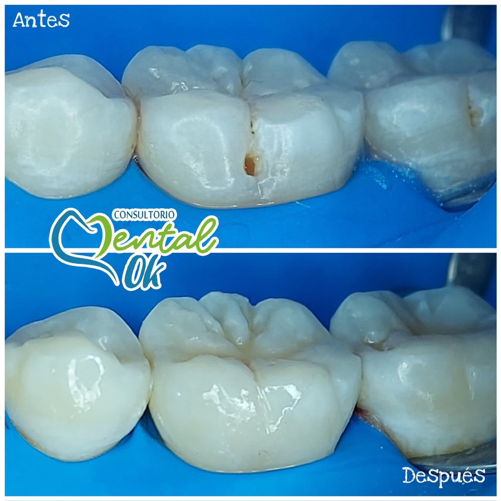 Antes y después de la restauración con resina de pequeñas caries en las muelas inferiores